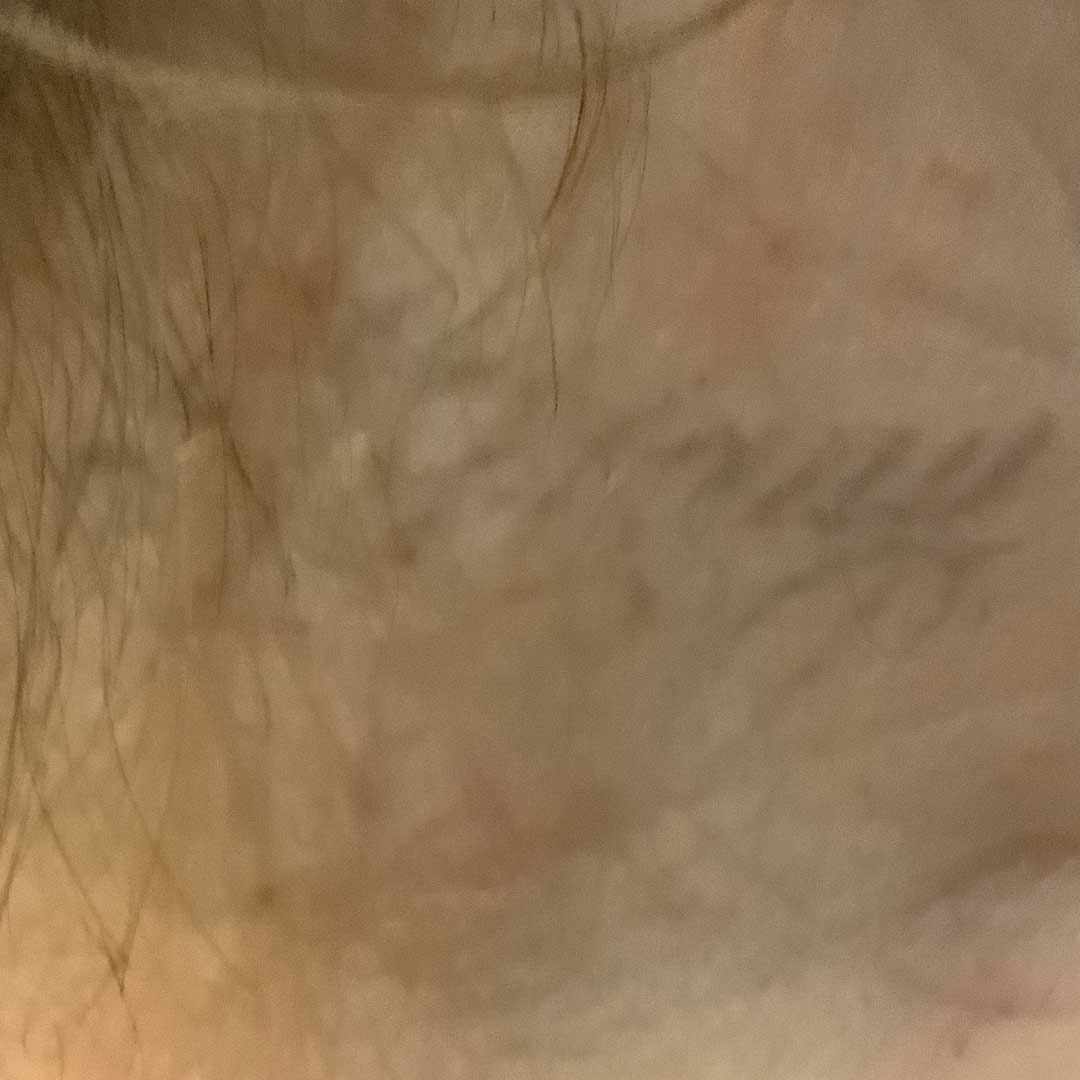 Tattoo Removal After Image