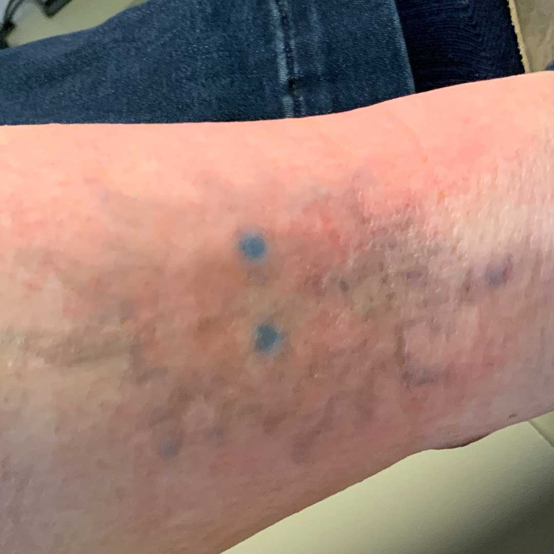 Tattoo Removal After Image